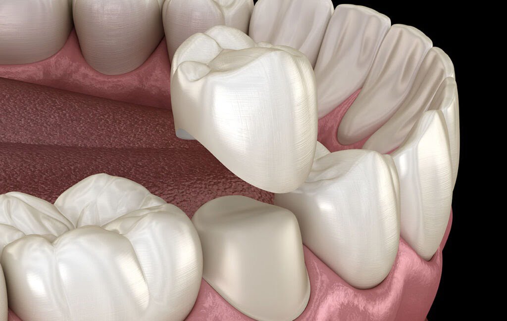 dental crowns