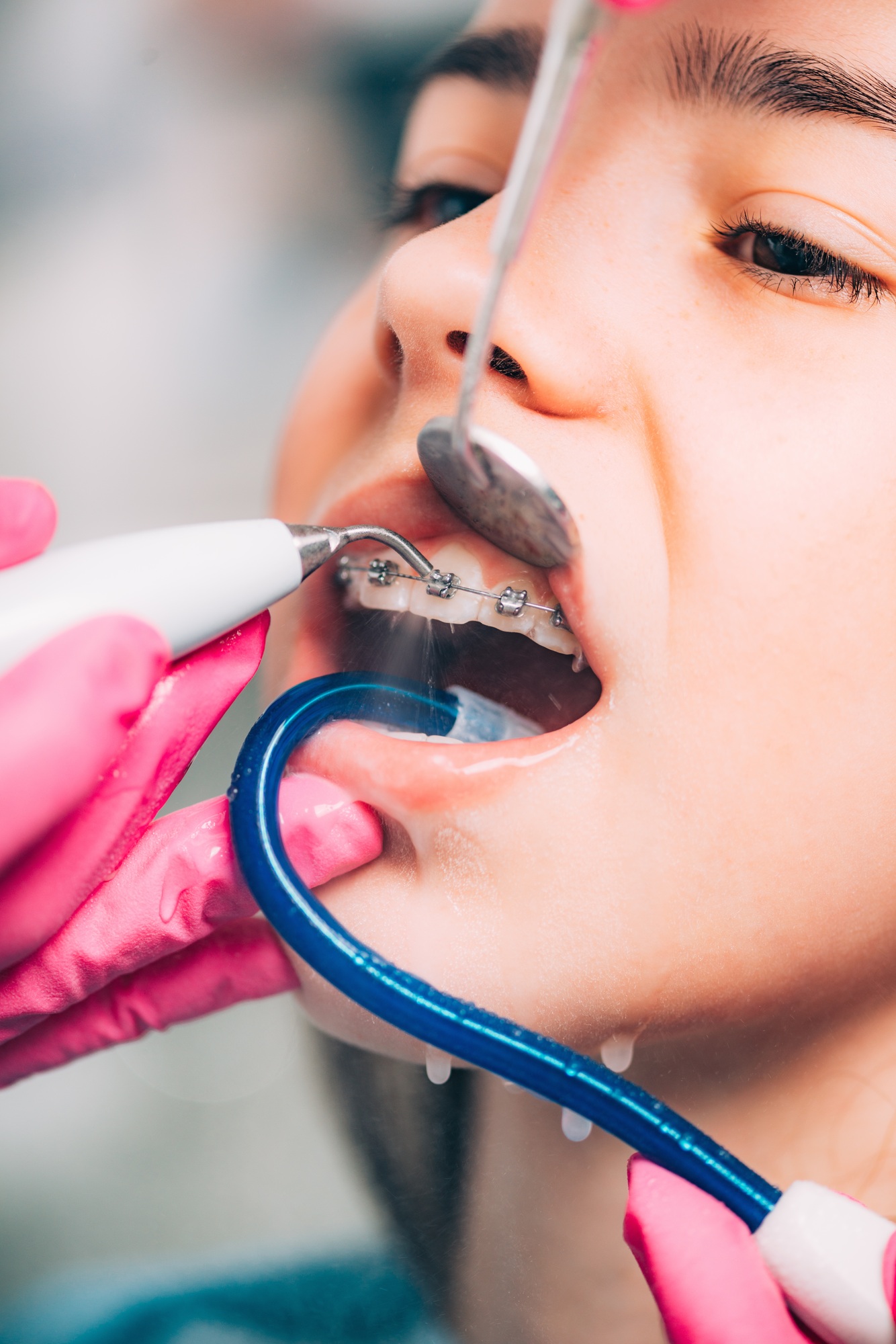 Orthodontist cleaning girl’s teeth with dental braces